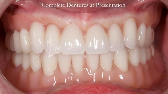 Newsletter 70 Complete Denture Treatment for Kate: A Case Study on Natural-Looking Dentures and Implant-Supported Overdentures