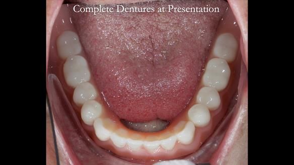 Newsletter 70 Complete Denture Treatment for Kate: A Case Study on Natural-Looking Dentures and Implant-Supported Overdentures