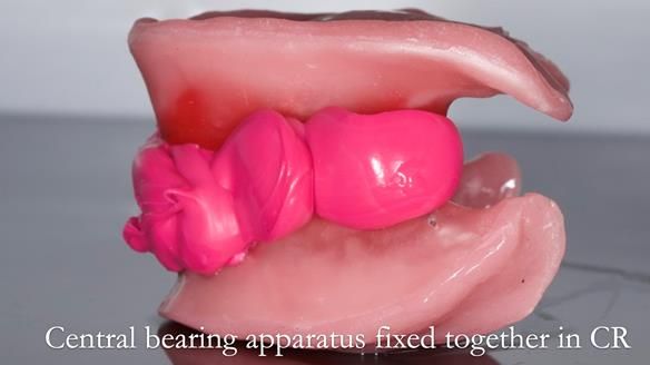 Replacing Madeline’s Complete denture FULL PROTOCOL