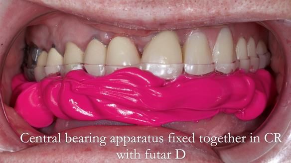 Newsletter 44 - extreme removable prosthodontics – engineering a super-strong and ultra-thin over denture