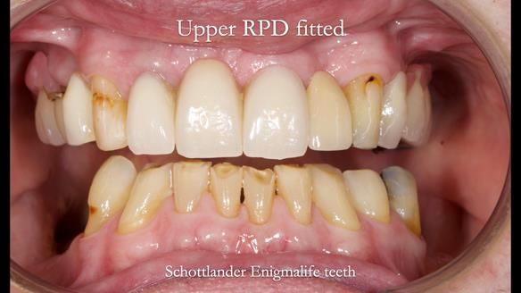 Managing Edgar “THE SCEPTIC” with an RPD/Splint FULL CASE