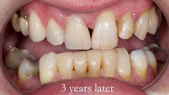 Read Newsletter 67 - Brian's COMBAT DENTURE Case Study