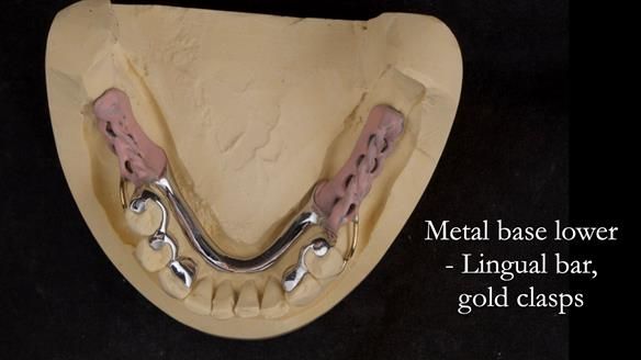 Solving Linda’s Failed “All on 4” implant bridges - full protocol Newsletter 42