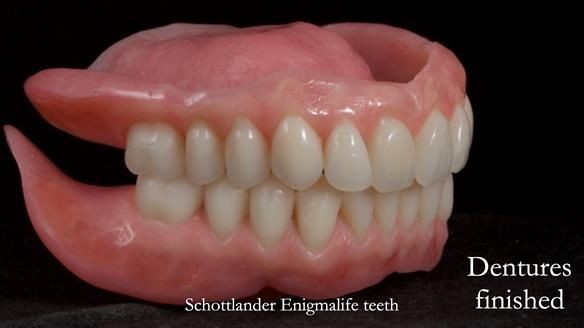 Newsletter 70 Complete Denture Treatment for Kate: A Case Study on Natural-Looking Dentures and Implant-Supported Overdentures