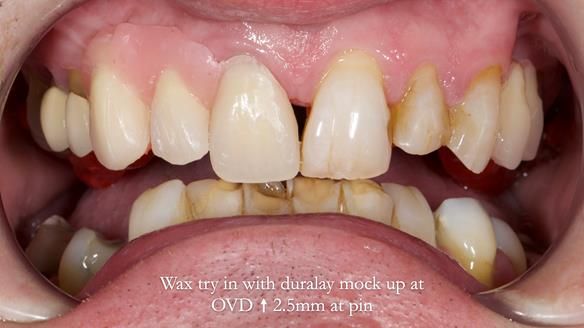 Read Newsletter 67 - Brian's COMBAT DENTURE Case Study