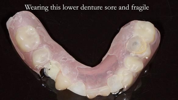 Newsletter 44 - extreme removable prosthodontics – engineering a super-strong and ultra-thin over denture