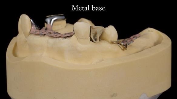 Managing Edgar “THE SCEPTIC” with an RPD/Splint FULL CASE