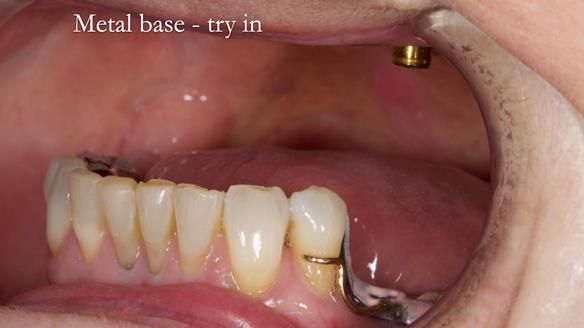 Solving Linda’s Failed “All on 4” implant bridges - full protocol Newsletter 42