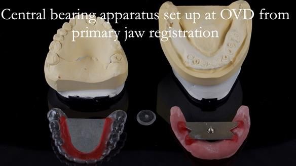 Newsletter 44 - extreme removable prosthodontics – engineering a super-strong and ultra-thin over denture