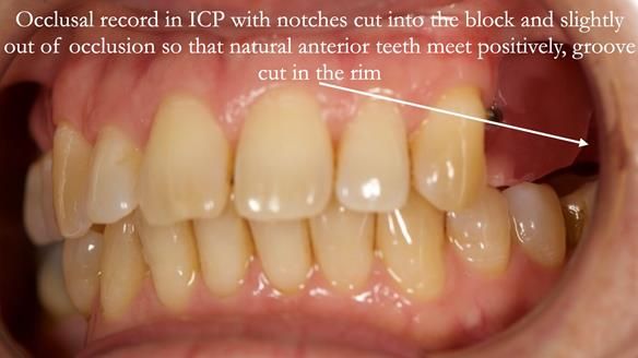 Solving Sue's failed implants with metal based RPD - full protocol Newsletter 43