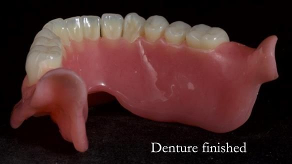 Newsletter 68 Restoring Jan’s Smile: Complete Dentures Inspired by Her Daughter’s Teeth - Post Mouth Surgery