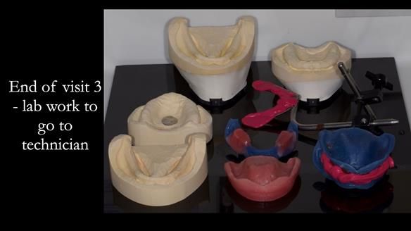 Newsletter 70 Complete Denture Treatment for Kate: A Case Study on Natural-Looking Dentures and Implant-Supported Overdentures