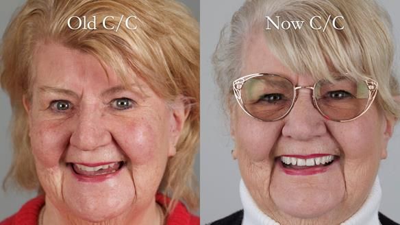 Replacing Madeline’s Complete denture FULL PROTOCOL