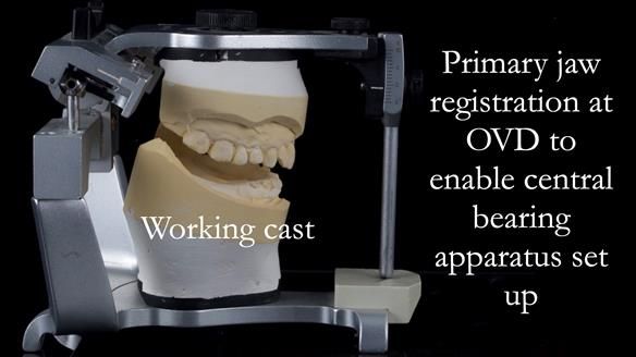 Newsletter 44 - extreme removable prosthodontics – engineering a super-strong and ultra-thin over denture