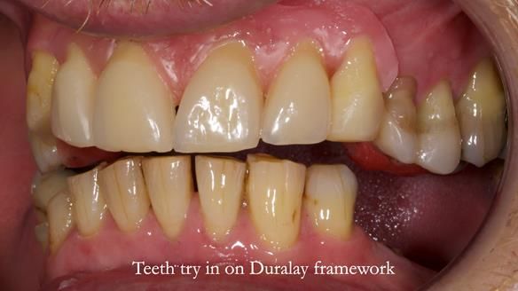 How Keith’s combat denture transformed his life – Newsletter 73