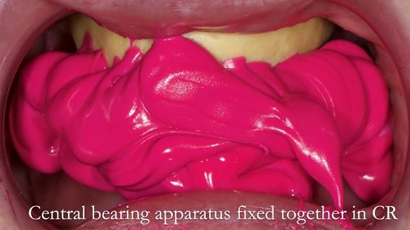 Replacing Madeline’s Complete denture FULL PROTOCOL