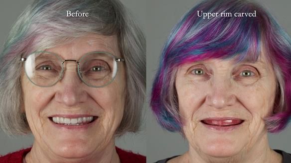 Newsletter 70 Complete Denture Treatment for Kate: A Case Study on Natural-Looking Dentures and Implant-Supported Overdentures