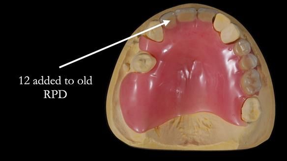 Managing Edgar “THE SCEPTIC” with an RPD/Splint FULL CASE