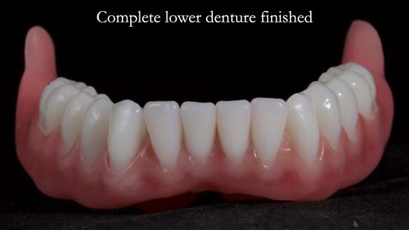 Newsletter 65 Marisa Provision of Complete Dentures on badly placed implants