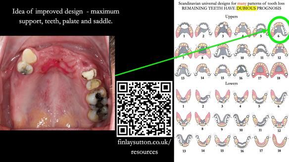 How Keith’s combat denture transformed his life – Newsletter 73