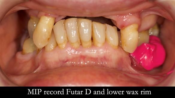 Newsletter 71 Jean’s Class I Mod III RPD: See my mistakes Fractured Mk1 to a Stronger Mk2 RPD (4 years on)