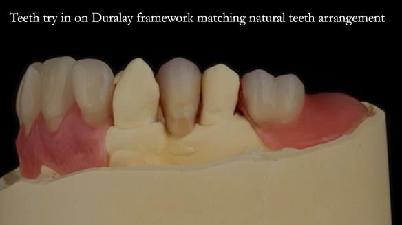 Newsletter 71 Jean’s Class I Mod III RPD: See my mistakes Fractured Mk1 to a Stronger Mk2 RPD (4 years on)