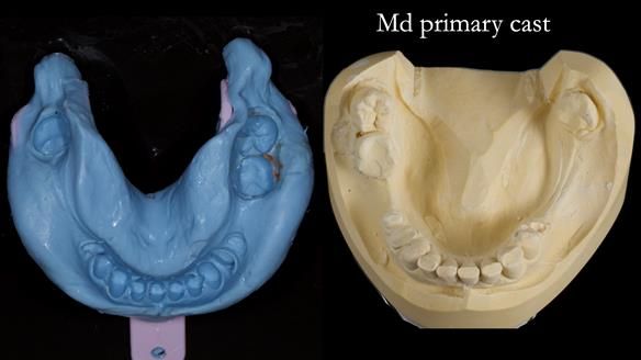 How Keith’s combat denture transformed his life – Newsletter 73