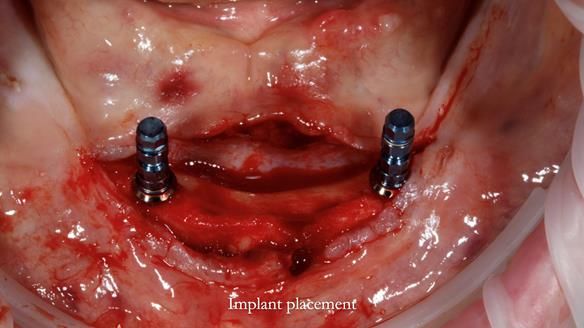 Newsletter 70 Complete Denture Treatment for Kate: A Case Study on Natural-Looking Dentures and Implant-Supported Overdentures