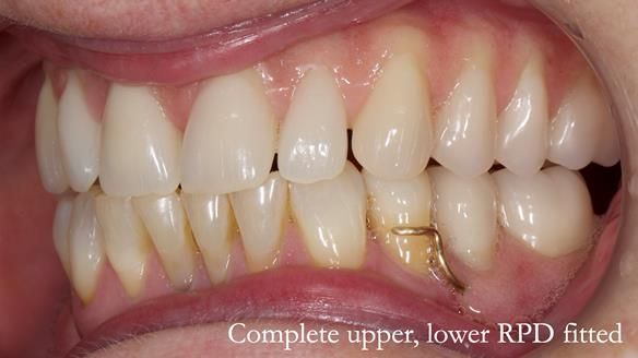 Solving Linda’s Failed “All on 4” implant bridges - full protocol Newsletter 42