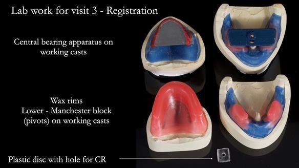 Newsletter 68 Restoring Jan’s Smile: Complete Dentures Inspired by Her Daughter’s Teeth - Post Mouth Surgery