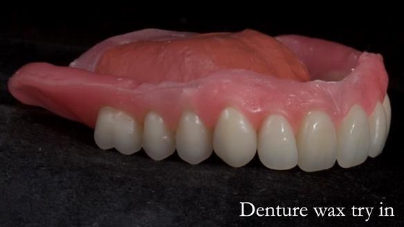 Newsletter 70 Complete Denture Treatment for Kate: A Case Study on Natural-Looking Dentures and Implant-Supported Overdentures