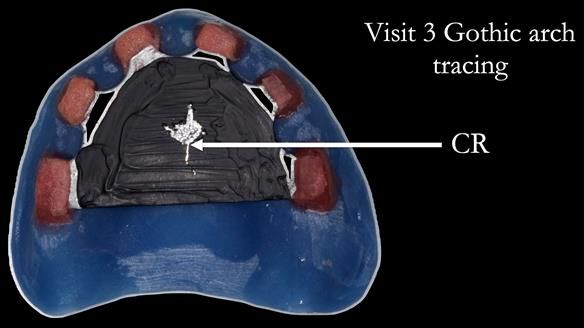 Newsletter 70 Complete Denture Treatment for Kate: A Case Study on Natural-Looking Dentures and Implant-Supported Overdentures