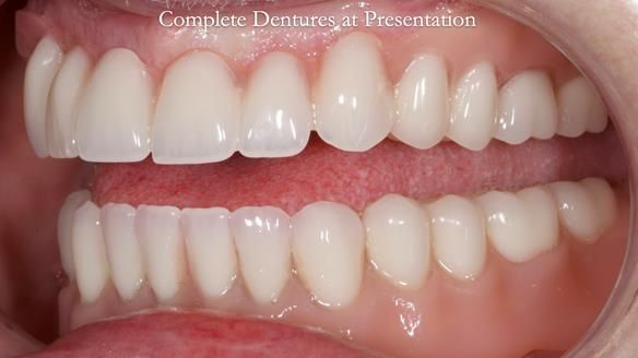 Newsletter 70 Complete Denture Treatment for Kate: A Case Study on Natural-Looking Dentures and Implant-Supported Overdentures