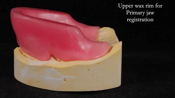 Newsletter 65 Marisa Provision of Complete Dentures on badly placed implants