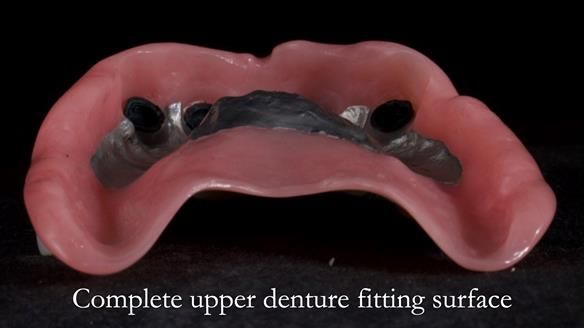 Newsletter 65 Marisa Provision of Complete Dentures on badly placed implants