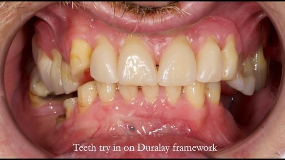 How Keith’s combat denture transformed his life – Newsletter 73