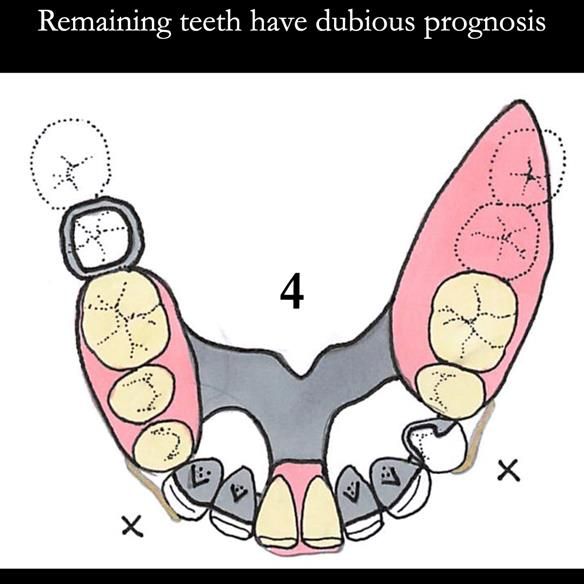 Universal Scandinavian partial denture designs