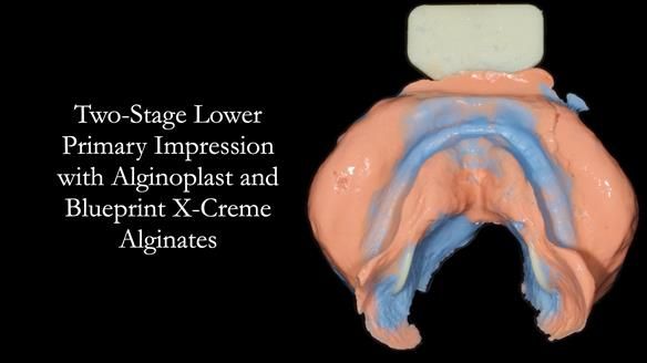 Newsletter 70 Complete Denture Treatment for Kate: A Case Study on Natural-Looking Dentures and Implant-Supported Overdentures