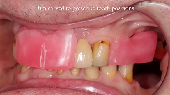 Managing Edgar “THE SCEPTIC” with an RPD/Splint FULL CASE