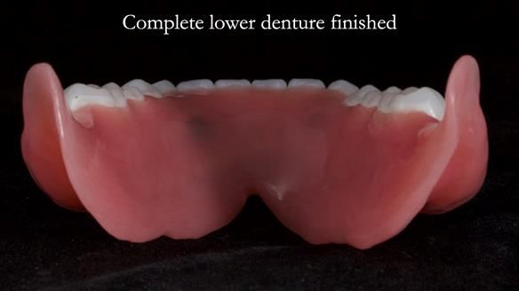 Newsletter 65 Marisa Provision of Complete Dentures on badly placed implants