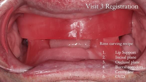 Newsletter 74: Ken’s Case Study Complete Dentures - Life Like and Age Appropriate