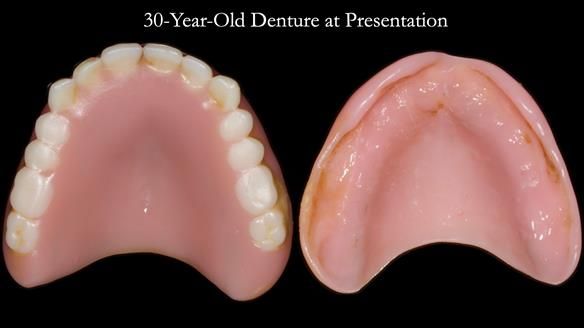 Newsletter 68 Restoring Jan’s Smile: Complete Dentures Inspired by Her Daughter’s Teeth - Post Mouth Surgery