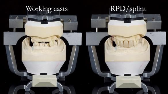 Managing Edgar “THE SCEPTIC” with an RPD/Splint FULL CASE