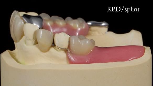 Managing Edgar “THE SCEPTIC” with an RPD/Splint FULL CASE