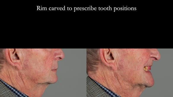 Managing Edgar “THE SCEPTIC” with an RPD/Splint FULL CASE