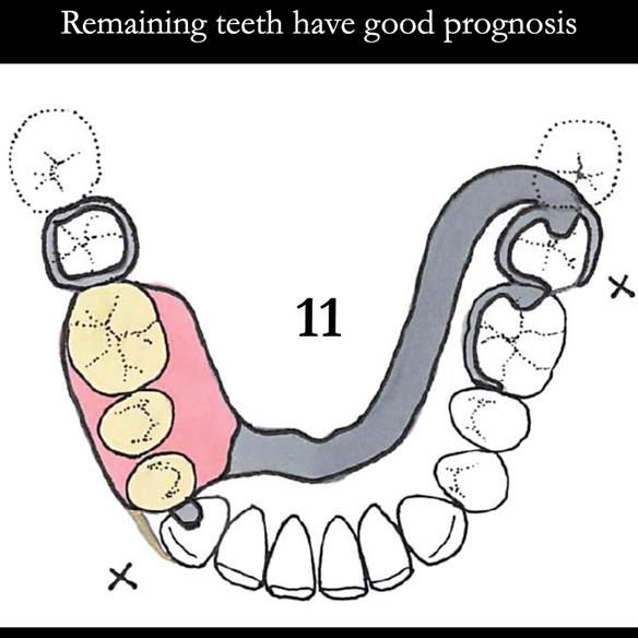 Universal Scandinavian partial denture designs