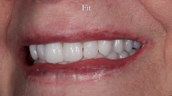 Newsletter 65 Marisa Provision of Complete Dentures on badly placed implants