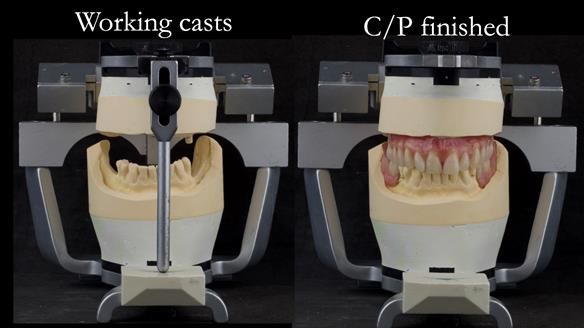 Solving Linda’s Failed “All on 4” implant bridges - full protocol Newsletter 42