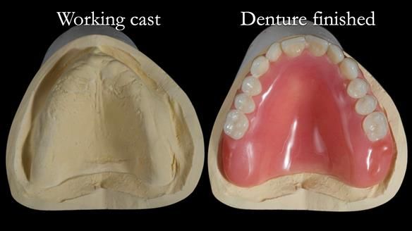 Newsletter 68 Restoring Jan’s Smile: Complete Dentures Inspired by Her Daughter’s Teeth - Post Mouth Surgery