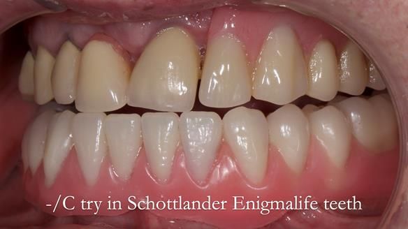 Newsletter 44 - extreme removable prosthodontics – engineering a super-strong and ultra-thin over denture